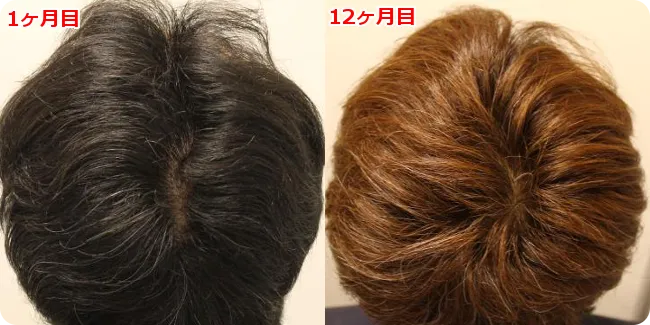 AGA治療前と現在