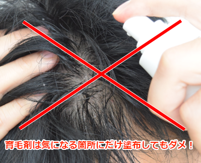 育毛剤は気になる部分だけでなく頭皮全体に塗布する必要がある
