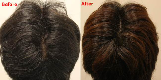 AGA治療前と治療後の頭皮の様子
