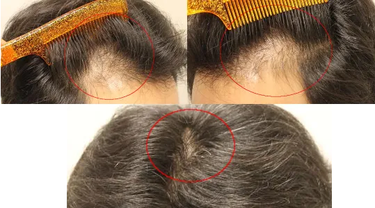 AGA治療 開始１ヶ月目の様子