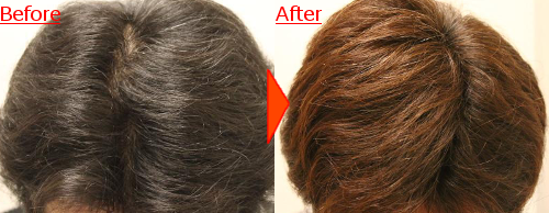 AGA治療前と治療後の頭皮の様子