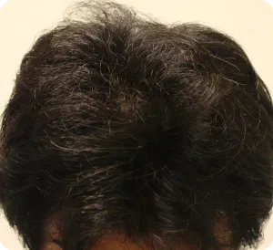 AGA治療 開始2ヶ月目の頭皮上