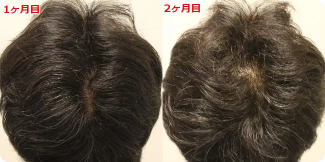 AGA治療 開始2ヶ月目の頭皮後ろ
