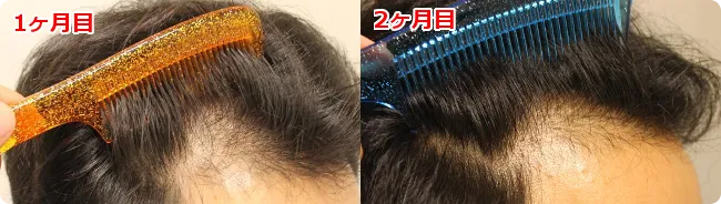 AGA治療 開始2ヶ月目の頭皮右側