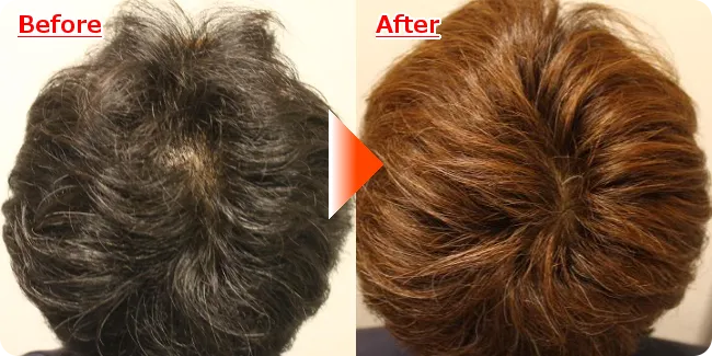 AGA治療前と治療後の頭皮の様子