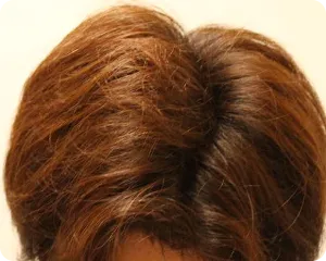 AGA治療 開始12ヶ月目の頭皮上