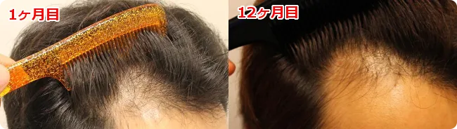 AGA治療 開始12ヶ月目の頭皮右側