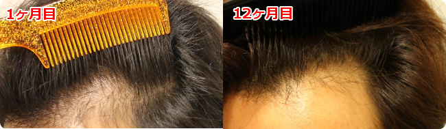 AGA治療 開始１２ヶ月目の頭皮左側