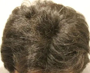 AGA治療 開始３ヶ月目の頭皮上