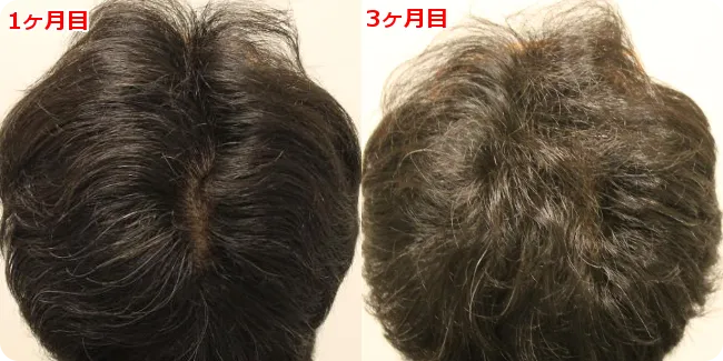 AGA治療 開始３ヶ月目の頭皮後ろ