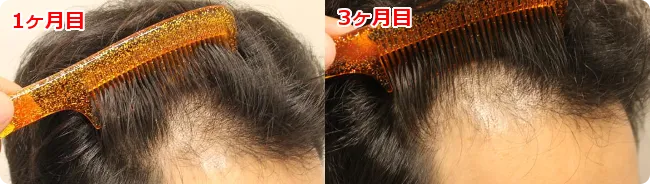 AGA治療 開始３ヶ月目の頭皮右側