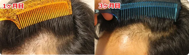 AGA治療 開始３ヶ月目の頭皮左側