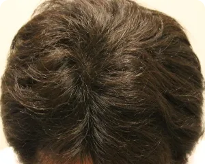 AGA治療 開始４ヶ月目の頭皮上