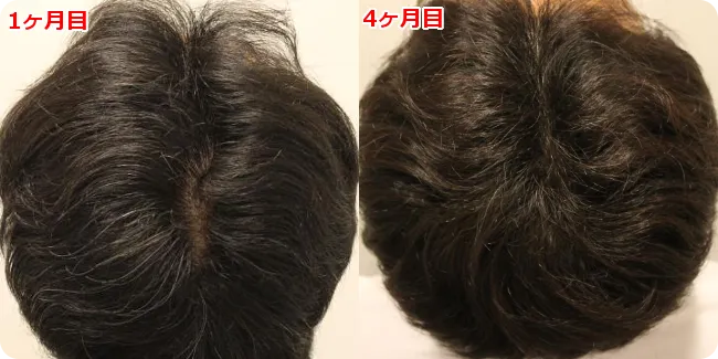AGA治療 開始４ヶ月目の頭皮後ろ