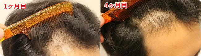 AGA治療 開始４ヶ月目の頭皮右側