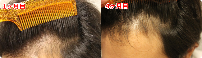 AGA治療 開始４ヶ月目の頭皮左側