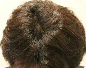 AGA治療 開始5ヶ月目の頭皮上