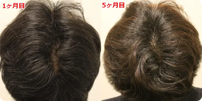 AGA治療 開始5ヶ月目の頭皮後ろ
