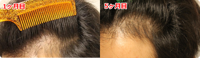 AGA治療 開始５ヶ月目の頭皮左側