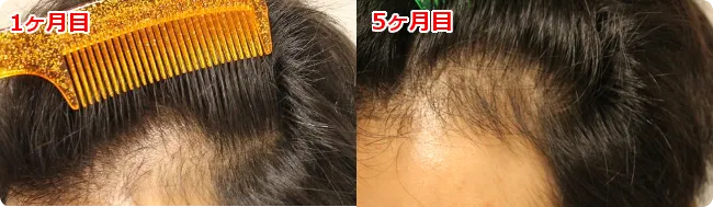 AGA治療 開始5ヶ月目の頭皮左側