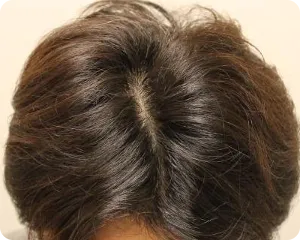 AGA治療 開始6ヶ月目の頭皮上