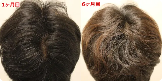 AGA治療 開始6ヶ月目の頭皮後ろ