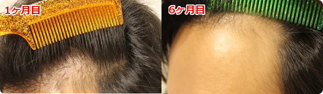 AGA治療 開始6ヶ月目の頭皮左側