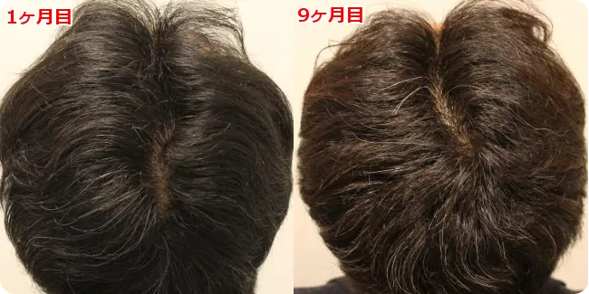 AGA治療 開始９ヶ月目の頭皮後ろ