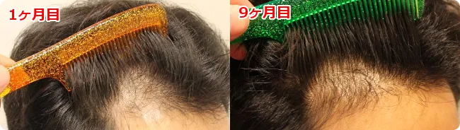 AGA治療 開始９ヶ月目の頭皮右側