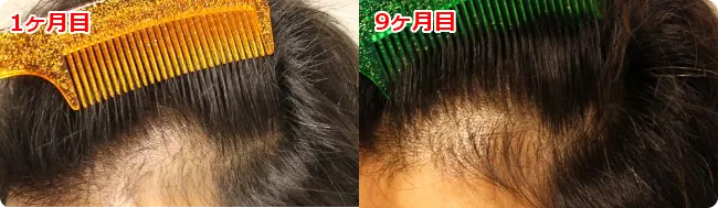 AGA治療 開始９ヶ月目の頭皮左側