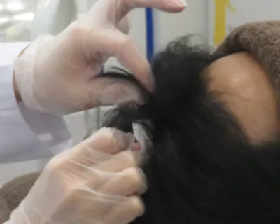 Dr.メソ施術前に頭皮の周りを消毒