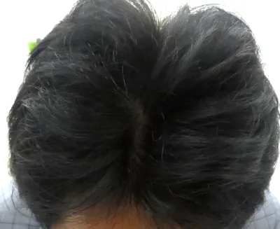 Dr.メソ施術後の頭皮の様子