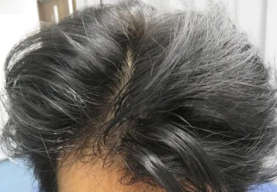 ミノキジェット施術後は頭皮が濡れる